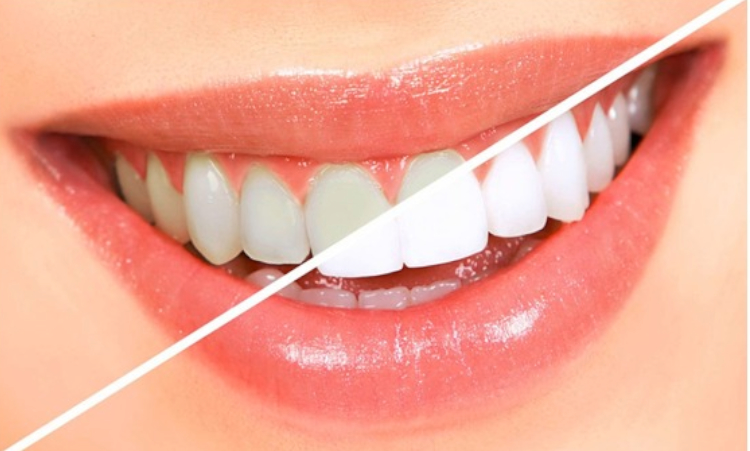 clareamento-dental-2