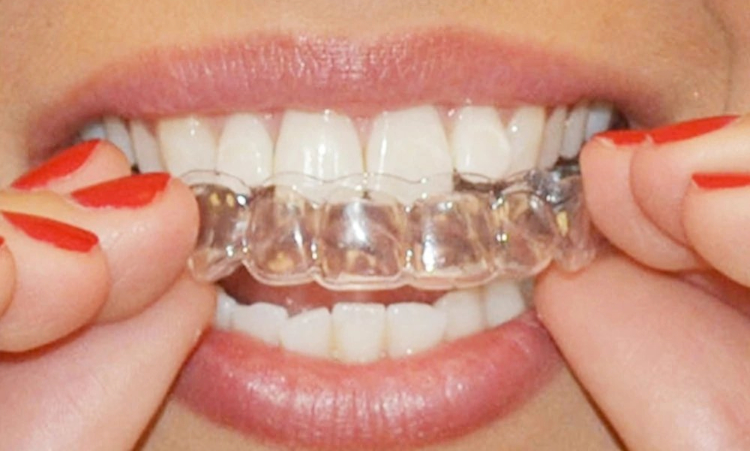 clareamento-dental-3